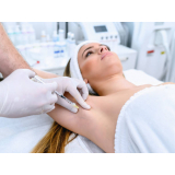 aplicação de botox nas axilas Vila Conceição