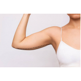 lipo enzimática no braço marcar Mirandópolis e Saúde