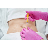 Lipo Enzimática Abdominal